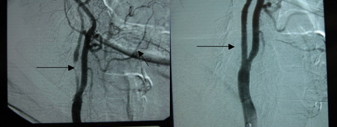 Traitement de la sténose de la carotide interne | Institut Cardiovasculaire - Cliniques ...