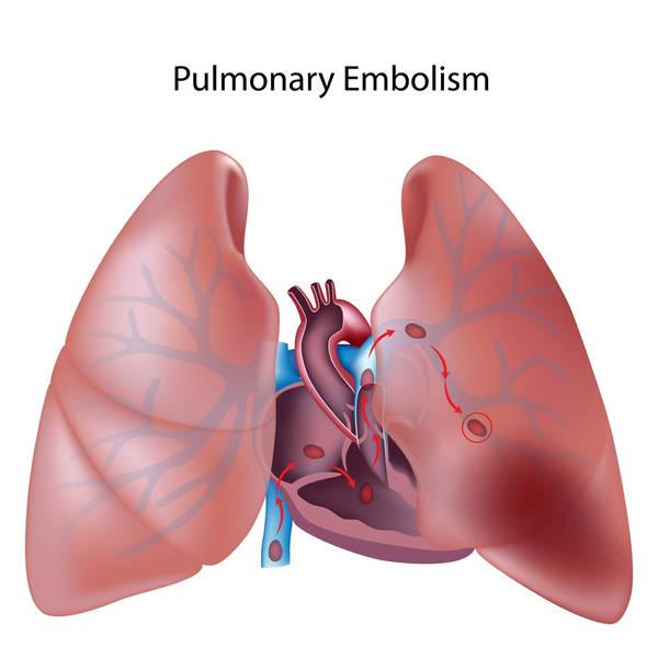 Embolie pulmonaire