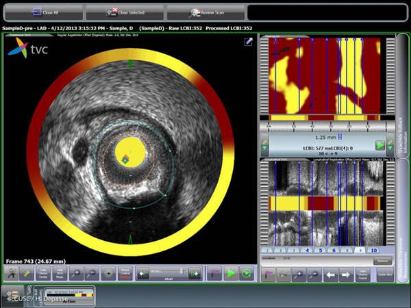 Une caméra spéciale, la spectroscopie, permet de voir l’intérieur des artères et d’y détecter les dépôts de cholestérol (représentés ici en jaune).